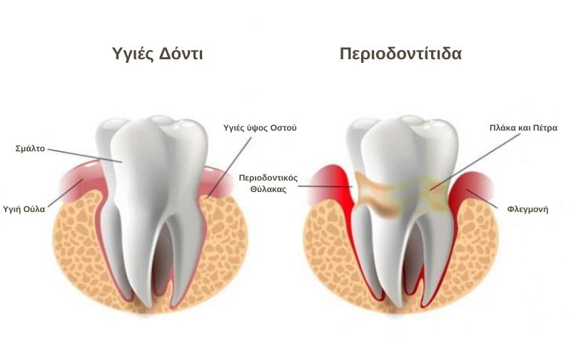 Periodontida Diatrofi